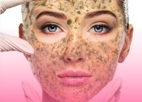 آلگاپیل تراپی محدثه صدر